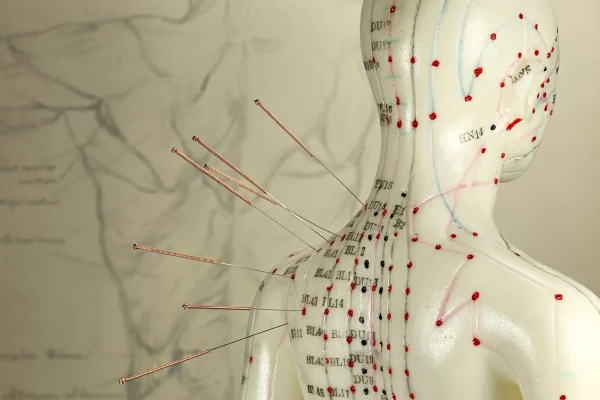 acupuncture for vertigo