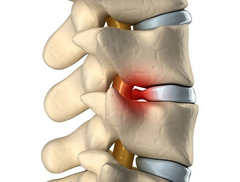 can chiropractic help bulging disc in back