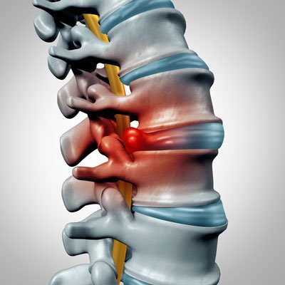 Herniated Disc Northbrook